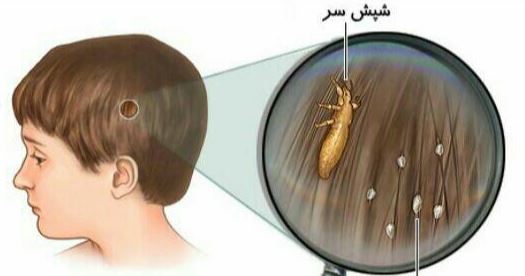 خصوصیات و ویژگی های شپش درکودکان و بزرگسالان