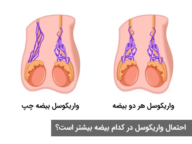 علائم واریکوسل چیست ؟ و راه های درمان آن