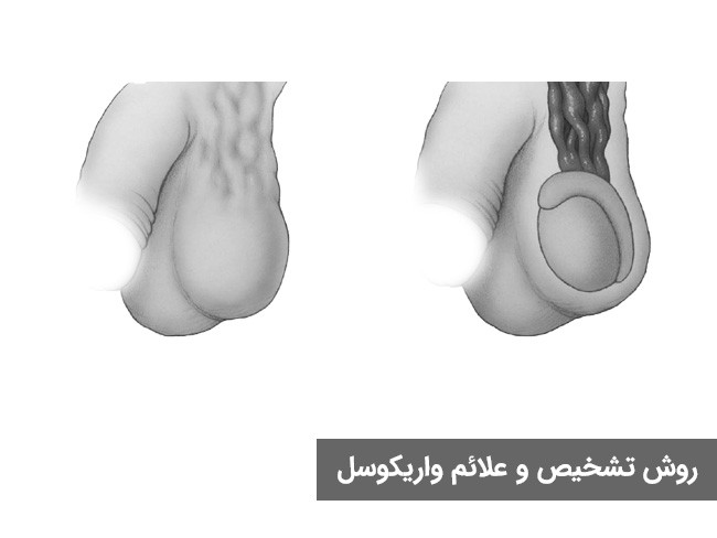 علائم واریکوسل چیست ؟ و راه های درمان آن