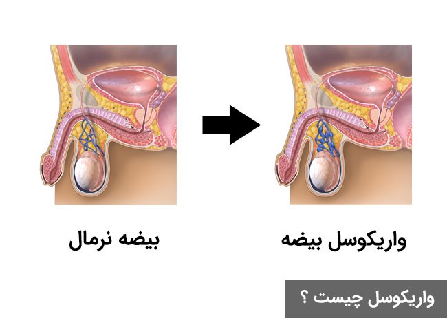 علائم واریکوسل چیست ؟ و راه های درمان آن